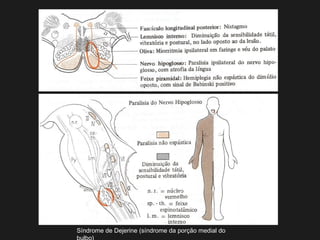 Síndrome de Dejerine (síndrome da porção medial do
 