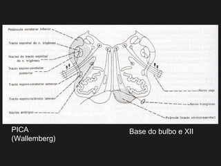 PICA
(Wallemberg)
Base do bulbo e XII
 