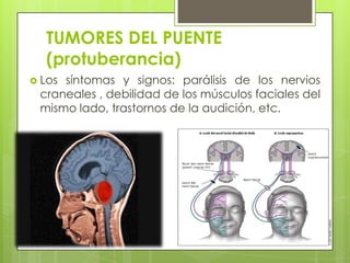 TUMORES DEL PUENTE
(protuberancia)
 Los

síntomas y signos: parálisis de los nervios
craneales , debilidad de los músculos faciales del
mismo lado, trastornos de la audición, etc.

 