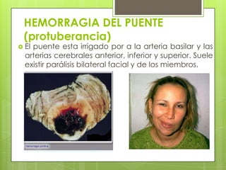HEMORRAGIA DEL PUENTE
(protuberancia)

 El

puente esta irrigado por a la arteria basilar y las
arterias cerebrales anterior, inferior y superior. Suele
existir parálisis bilateral facial y de los miembros.

 