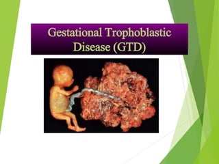 Gestational Trophoblastic
Disease (GTD)
 