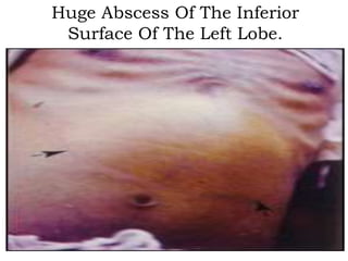 Huge Abscess Of The Inferior
Surface Of The Left Lobe.
 