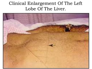 Clinical Enlargement Of The Left
Lobe Of The Liver.
 