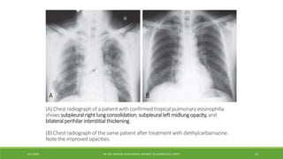 (A) Chest radiograph of a patient with confirmed tropical pulmonary eosinophilia
shows subpleural rightlung consolidation, subpleuralleft midlung opacity,and
bilateral perihilar interstitial thickening.
(B) Chest radiograph of the same patient after treatment with diethylcarbamazine.
Note the improved opacities.
4/27/2023 DR. MD. SHAFIQUL ISLAM DEWAN, RESIDENT (PULMONOLOGY), DMCH 12
 