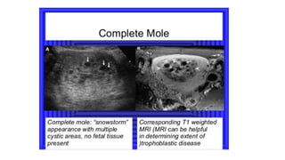 Tropoblastic diseases