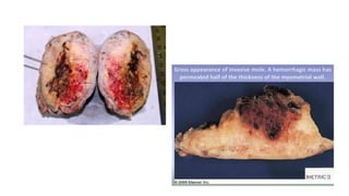 Tropoblastic diseases