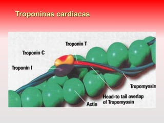 Troponinas cardiacas 
 
