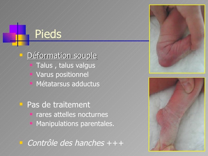 Troubles De La Statique Chez L Enfant Mrg 13 01 09