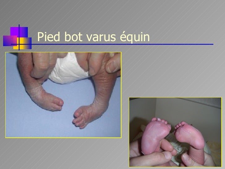 Troubles De La Statique Chez L Enfant Mrg 13 01 09