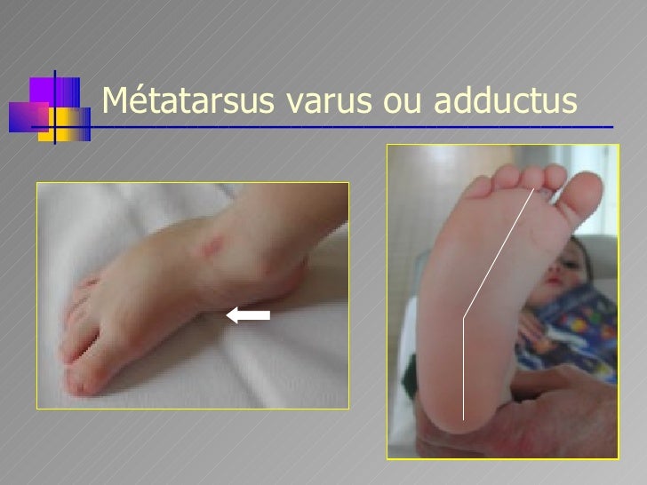 Troubles De La Statique Chez L Enfant Mrg 13 01 09