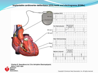 Implantable cardioverter defibrillator (ICD) leads and electrograms (EGMs).
Charles D. Swerdlow et al. Circ Arrhythm Electrophysiol.
2014;7:1237-1261
Copyright © American Heart Association, Inc. All rights reserved.
 
