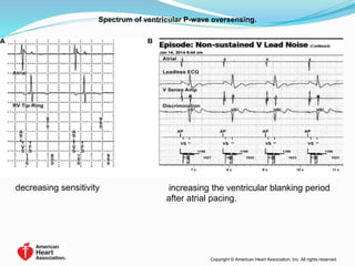 Spectrum of ventricular P-wave oversensing.
Copyright © American Heart Association, Inc. All rights reserved.
decreasing sensitivity increasing the ventricular blanking period
after atrial pacing.
 