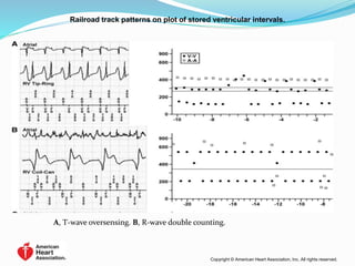 Railroad track patterns on plot of stored ventricular intervals.
Copyright © American Heart Association, Inc. All rights reserved.
A, T-wave oversensing. B, R-wave double counting.
 