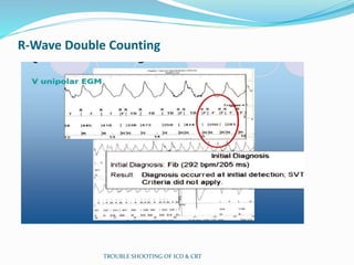 R-Wave Double Counting
TROUBLE SHOOTING OF ICD & CRT
 