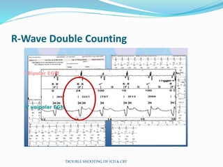 R-Wave Double Counting
TROUBLE SHOOTING OF ICD & CRT
 