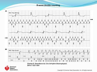 R-wave double counting.
Charles D. Swerdlow et al. Circ Arrhythm Electrophysiol.
2014;7:1237-1261
Copyright © American Heart Association, Inc. All rights reserved.
 