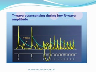 TROUBLE SHOOTING OF ICD & CRT
 