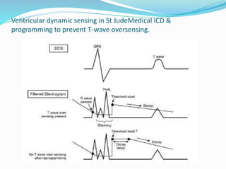 Ventricular dynamic sensing in St JudeMedical ICD &
programming to prevent T-wave oversensing.
 