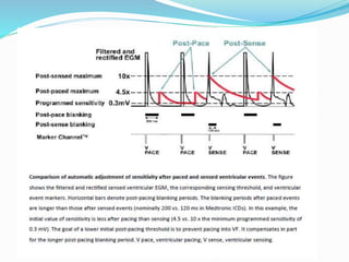 TROUBLE SHOOTING OF ICD & CRT
 