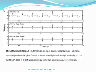 TROUBLE SHOOTING OF ICD & CRT
 