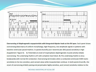 TROUBLE SHOOTING OF ICD & CRT
 