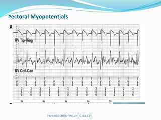 Pectoral Myopotentials
TROUBLE SHOOTING OF ICD & CRT
 