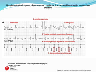Nonphysiological signals of pace-sense conductor fracture and lead-header connection
problem.
Charles D. Swerdlow et al. Circ Arrhythm Electrophysiol.
2014;7:1237-1261
Copyright © American Heart Association, Inc. All rights reserved.
 