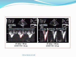TIPS & TRICKS OF CRT
 