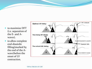 to maximize DFT
(i.e. separation of
the E- and A-
waves).
 to allow complete
end-diastolic
filling(marked by
the end of the A-
wave)before the
onset of LV
contraction.
TIPS & TRICKS OF CRT
 