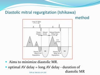 Diastolic mitral regurgitation (Ishikawa)
method
 Aims to minimize diastolic MR.
 optimal AV delay = long AV delay - duration of
diastolic MRTIPS & TRICKS OF CRT
 