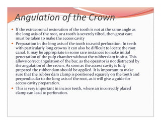 Trouble shooting in endodontics | PDF