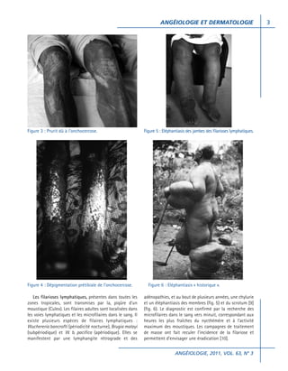 ANGÉIOLOGIE ET DERMATOLOGIE

Figure 3 : Prurit dû à l’onchocercose.

Figure 4 : Dépigmentation prétibiale de l’onchocercose.
Les filarioses lymphatiques, présentes dans toutes les
zones tropicales, sont transmises par la, piqûre d’un
moustique (Culex). Les filaires adultes sont localisées dans
les voies lymphatiques et les microfilaires dans le sang. Il
existe plusieurs espèces de filaires lymphatiques :
Wuchereria bancrofti (périodicité nocturne), Brugia malayi
(subpériodique) et W. b. pacifica (apériodique). Elles se
manifestent par une lymphangite rétrograde et des

Figure 5 : Eléphantiasis des jambes des filarioses lymphatiques.

Figure 6 : Eléphantiasis « historique ».
adénopathies, et au bout de plusieurs années, une chylurie
et un éléphantiasis des membres (fig. 5) et du scrotum [9]
(fig. 6). Le diagnostic est confirmé par la recherche des
microfilaires dans le sang vers minuit, correspondant aux
heures les plus fraîches du nycthémère et à l’activité
maximum des moustiques. Les campagnes de traitement
de masse ont fait reculer l’incidence de la filariose et
permettent d’envisager une éradication [10].
ANGÉIOLOGIE, 2011, VOL. 63, N° 3

3

 