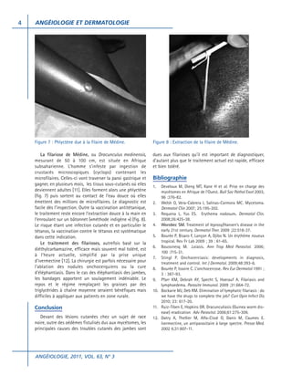 4

ANGÉIOLOGIE ET DERMATOLOGIE

Figure 7 : Phlyctène due à la filaire de Médine.

Figure 8 : Extraction de la filaire de Médine.

La filariose de Médine, ou Dracunculus medinensis,
mesurant de 50 à 100 cm, est située en Afrique
subsaharienne. L’homme s’infeste par ingestion de
crustacés microscopiques (cyclops) contenant les
microfilaires. Celles-ci vont traverser la paroi gastrique et
gagner, en plusieurs mois, les tissus sous-cutanés où elles
deviennent adultes [11]. Elles forment alors une phlyctène
(fig. 7) puis sortent au contact de l’eau douce où elles
émettent des millions de microfilaires. Le diagnostic est
facile dès l’inspection. Outre la vaccination antitétanique,
le traitement reste encore l’extraction douce à la main en
l’enroulant sur un bâtonnet («méthode indigène ») (fig. 8).
Le risque étant une infection cutanée et en particulier le
tétanos, la vaccination contre le tétanos est systématique
dans cette indication.
Le traitement des filarioses, autrefois basé sur la
diéthylcarbamazine, efficace mais souvent mal toléré, est
à l’heure actuelle, simplifié par la prise unique
d’ivermectine [12]. La chirurgie est parfois nécessaire pour
l’ablation des nodules onchocerquiens ou la cure
d’éléphantiasis. Dans le cas des éléphantiasis des jambes,
les bandages apportent un soulagement indéniable. Le
repos et le régime remplaçant les graisses par des
triglycérides à chaîne moyenne seraient bénéfiques mais
difficiles à appliquer aux patients en zone rurale.

dues aux filarioses qu’il est important de diagnostiquer,
d’autant plus que le traitement actuel est rapide, efficace
et bien toléré.

Conclusion
Devant des lésions cutanées chez un sujet de race
noire, outre des oédèmes fistulisés dus aux mycétomes, les
principales causes des troubles cutanés des jambes sont

ANGÉIOLOGIE, 2011, VOL. 63, N° 3

Bibliographie
1.

Develoux M, Dieng MT, Kane H et al. Prise en charge des
mycétomes en Afrique de l’Ouest. Bull Soc Pathol Exot 2003,
96 :376-82.
2. Welsh O, Vera-Cabrera I, Salinas-Carmora MC. Mycetoma.
Dermatol Clin 2007; 25:195-202.
3. Requena L, Yus ES. Erythema nodosum. Dermatol Clin.
2008;26:425-38.
4. Worobec SM. Treatment of leprosy/Hansen’s disease in the
early 21st century. Dermatol Ther. 2009 ;22:518-37.
5. Bourée P, Bisaro F, Lançon A, Djibo N. Un érythème noueux
tropical. Rev Fr Lab 2009 ; 39 : 61-65.
6. Boussinesq M. .Loiasis. Ann Trop Med Parasitol. 2006;
100 :715-31.
7. Stingl P. Onchocerciasis: developments in diagnosis,
treatment and control. Int J Dermatol. 2009;48:393-6.
8. Bourée P, Issoire C. L’onchocercose. Rev Eur Dermatol 1991 ;
3 : 387-93.
9. Pfarr KM, Debrah AY, Specht S, Hoerauf A. Filariasis and
lymphoedema. Parasite Immunol. 2009 ;31:664-72.
10. Bockarie MJ, Deb RM. Elimination of lymphatic filariasis : do
we have the drugs to complete the job? Curr Opin Infect Dis
2010; 23: 617-20.
11. Ruiz-Tiben E, Hopkins DR. Dracunculiasis (Guinea worm disease) eradication Adv Parasitol. 2006;61:275-309.
12. Datry A, Thellier M, Alfa-Cissé O, Danis M, Caumes E.
Ivermectine, un antiparasitaire à large spectre. Presse Med.
2002 6;31:607-11.

 