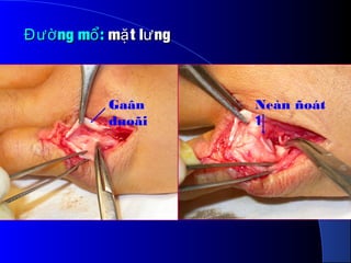ng m :Đườ ổng m :Đườ ổ m t l ngặ ưm t l ngặ ư
Gaân
duoãi
Neàn ñoát
1
 