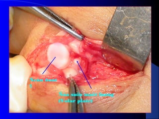 Ñóa suïn maët loøng
(Volar plate)
Neàn ñoát
1
 