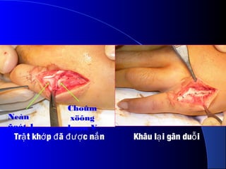 Tr t kh p ã c n nậ ớ đ đượ ắ Khâu l i gân du iạ ỗ
Neàn
ñoát 1
Choûm
xöông
baøn V
 