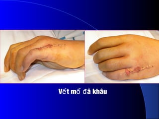 V t m ã khâuế ổ đ
 