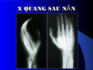 X QUANG SAU N NẮX QUANG SAU N NẮ
 