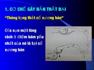1. C CH GÂY N N TH T B IƠ Ế Ắ Ấ Ạ1. C CH GÂY N N TH T B IƠ Ế Ắ Ấ Ạ
a s n m t lòngĐĩ ụ ặ
rách i m bám y uở đ ể ế
nh t c a nó là t i cấ ủ ạ ổ
x ng bànươ
““Thòng l ng th t c x ng bàn”ọ ắ ổ ươThòng l ng th t c x ng bàn”ọ ắ ổ ươ
 