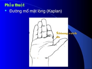 Ñöôøng raïch
da
Ph u thu tẫ ậ
 ng m m t lòng (Kaplan)Đườ ổ ặ
 