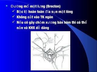  ng m m t l ng (Brecton)Đườ ổ ặ ư
 B c l hoàn toàn a s n m t lòngộ ộ đĩ ụ ặ
 Không c t vào TK ngónắ
 N u có gãy ch m x ng bàn kèm thì có thế ỏ ươ ể
n n và KHX d dàngắ ễ
 
