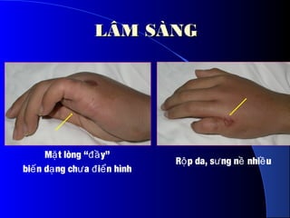 R p da, s ng n nhi uộ ư ề ề
M t lòng “ y”ặ đầ
bi n d ng ch a i n hìnhế ạ ư đ ể
LÂM SÀNGLÂM SÀNG
 