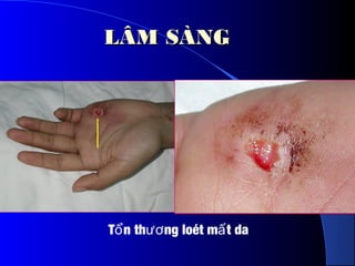 T n th ng loét m t daổ ươ ấ
LÂM SÀNGLÂM SÀNG
 