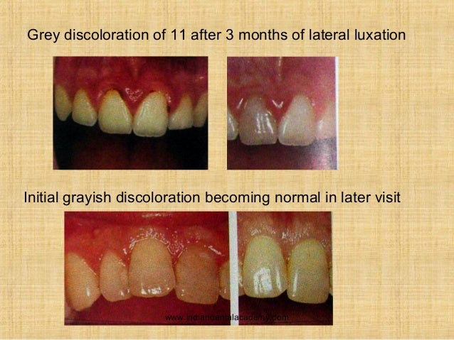 tooth luxation