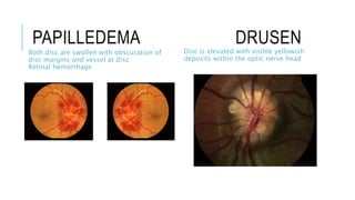 PAPILLEDEMA DRUSEN
Both disc are swollen with obscuration of
disc margins and vessel at disc
Retinal hemorrhage
Disc is elevated with visible yellowish
deposits within the optic nerve head
 