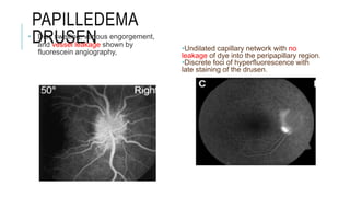 PAPILLEDEMA
DRUSEN
• Disc swelling, venous engorgement,
and vessel leakage shown by
fluorescein angiography, •Undilated capillary network with no
leakage of dye into the peripapillary region.
•Discrete foci of hyperfluorescence with
late staining of the drusen.
 