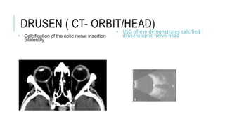 DRUSEN ( CT- ORBIT/HEAD)
• Calcification of the optic nerve insertion
bilaterally
• USG of eye demonstrates calcified (
drusen) optic nerve head
 
