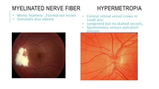 MYELINATED NERVE FIBER HYPERMETROPIA
• White, feathery ,Fanned out lesion
• Simulates disc edema
• Central retinal vessel crows in
small disc
• congested but no dialted vessels,
• Sponteneous venous pulsation
present
 