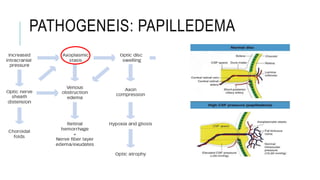 PATHOGENEIS: PAPILLEDEMA
 
