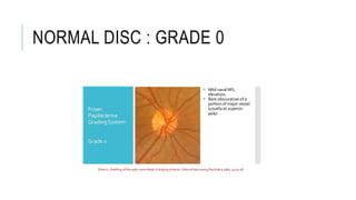 NORMAL DISC : GRADE 0
 
